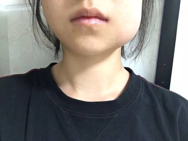 岛国一位妹纸拔完智齿的样子,duang~可爱加倍!