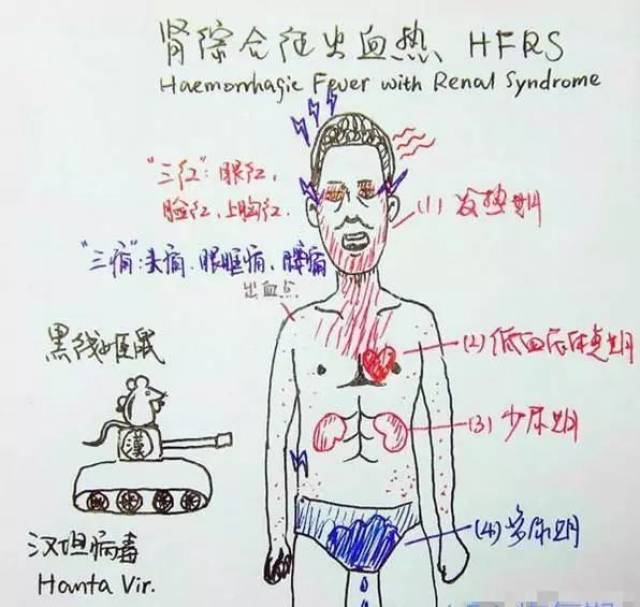 上图为某医学生手绘流行性出血热的主要症状,分期经过以及病原体