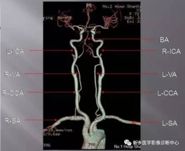 35种头颈部血管cta检查常见变异汇总