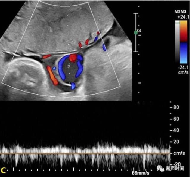 产前超声:胎儿脐静脉扩张并血栓