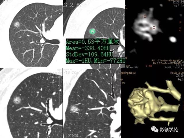 ct征象对早期肺腺癌亚型分型价值探讨之二平均ct值测量