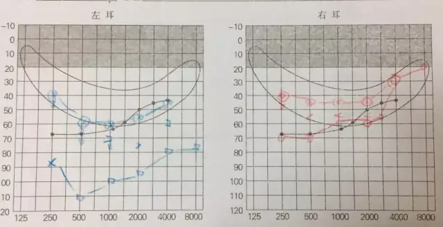 非对称性听力损失干预康复,给你不一般的听觉世界