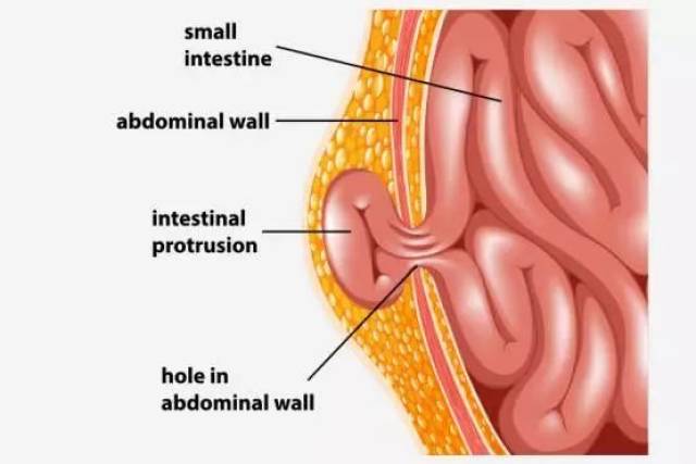疝气按照发生的部位分为很多种, 而在儿童中,最常见的疝气是腹股沟疝