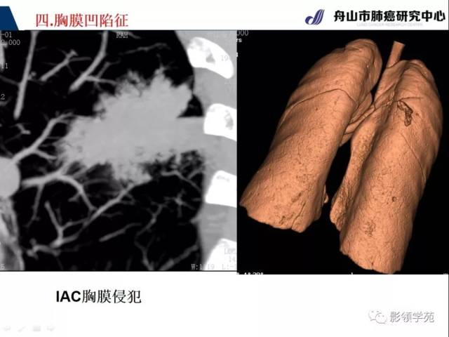 ct征象对早期肺腺癌分型之胸膜凹陷征