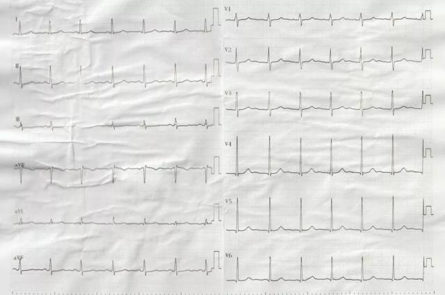 3. 心电图:窦性心律,81次/分,左室高电压