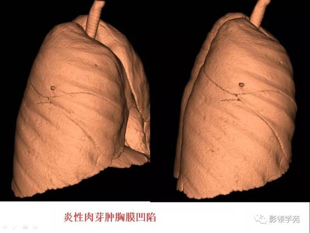 ct征象对早期肺腺癌分型之胸膜凹陷征