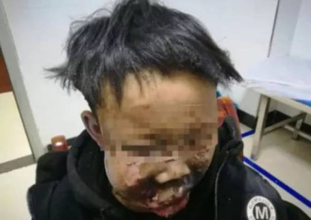 4  少年放鞭炮炸鱼遇哑炮  面部被炸成重伤  1月24日 湖南郴州一位13