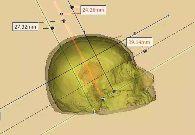 3d下重建出头颅3维模型与颅内血肿,定位血肿与体表标志及颅内结构