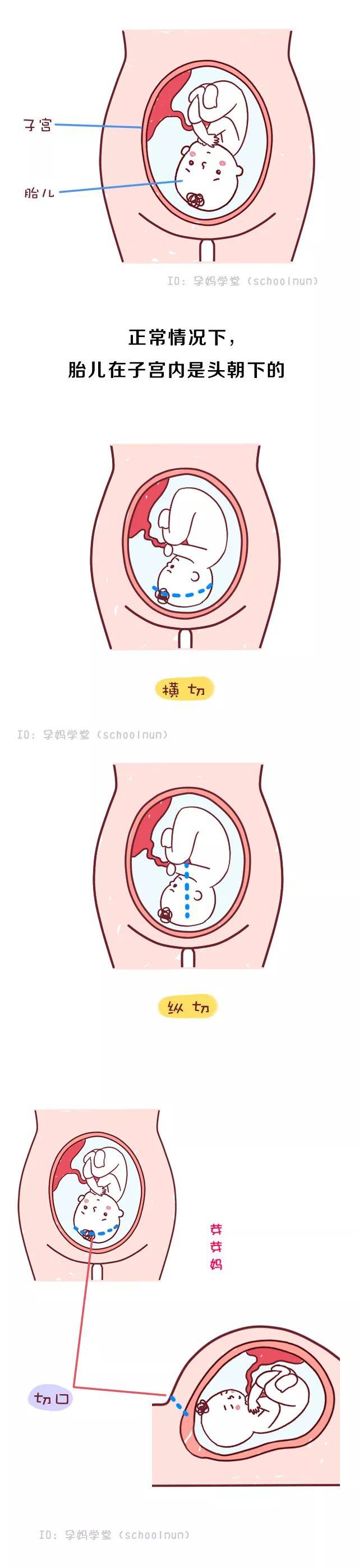 剖腹产要挨几刀,缝几层?看完心疼女人!