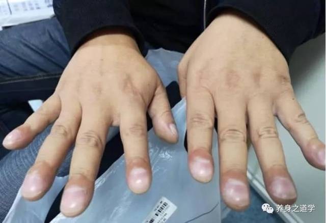 很可能是肺癌来了,有一位41岁的李先生,在三个月前发现自己的手指粗细