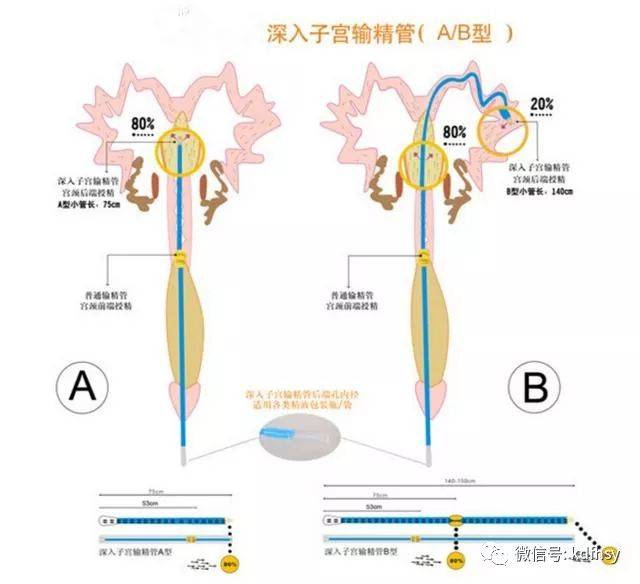 深部输精管可将精液输送到子宫角,更有利于精子到达输卵管中,提高受精