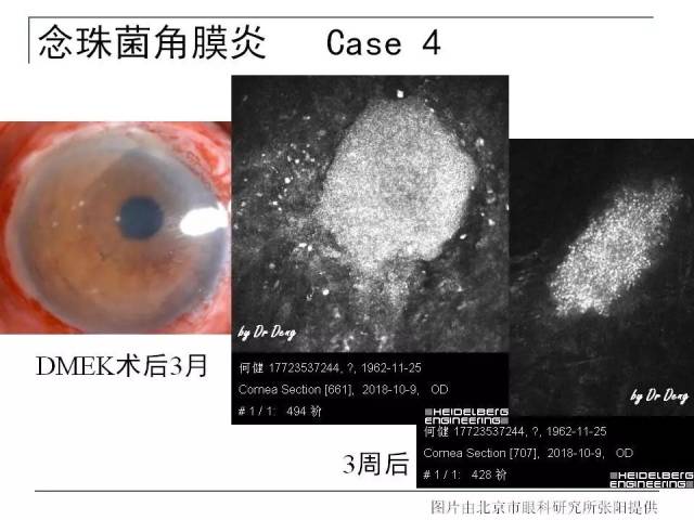 真菌感染ivcm判读依据