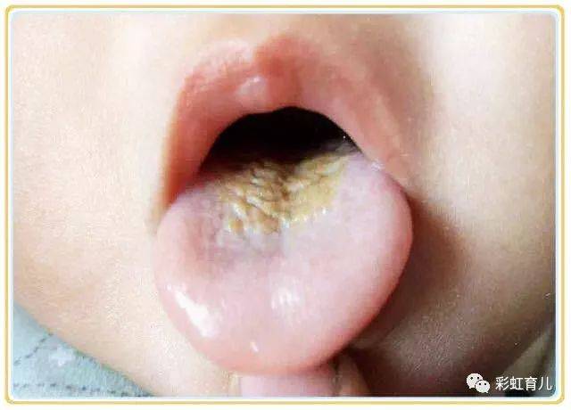 舌苔黄厚
