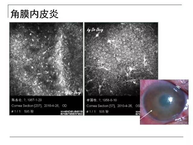 病毒性角膜内皮炎临床较常见,表现为角膜局限或弥漫的水肿,羊脂状kp