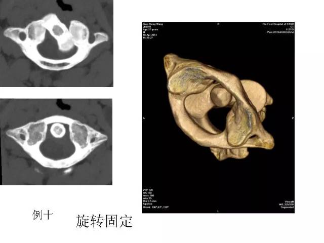 寰枢关节脱位影像诊断 | 影像天地