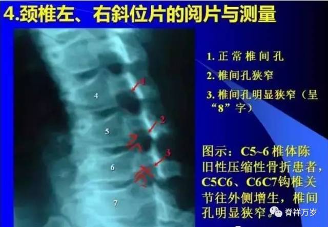 颈椎左右斜位片的阅片与测量