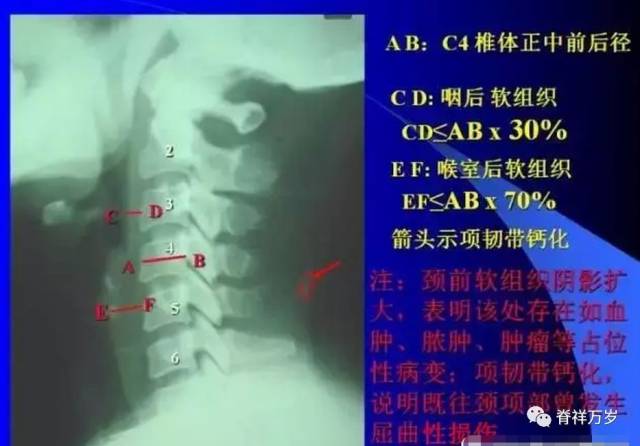 x光片 解析颈椎病