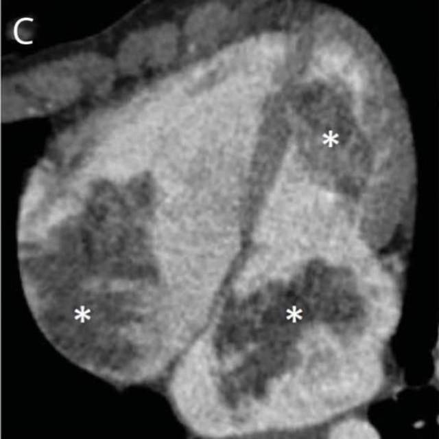 neurology:carney 综合征又一例,多发心房粘液瘤罕见