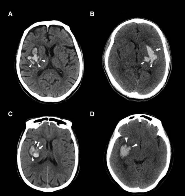 预测自发性脑出血血肿扩大的ct征象,不学就out了!_手机搜狐网