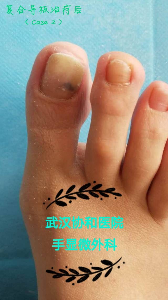 嵌甲性甲沟炎的保守及手术治疗 (原创)