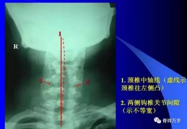 1颈椎中轴线 2两侧钩椎关节间隙