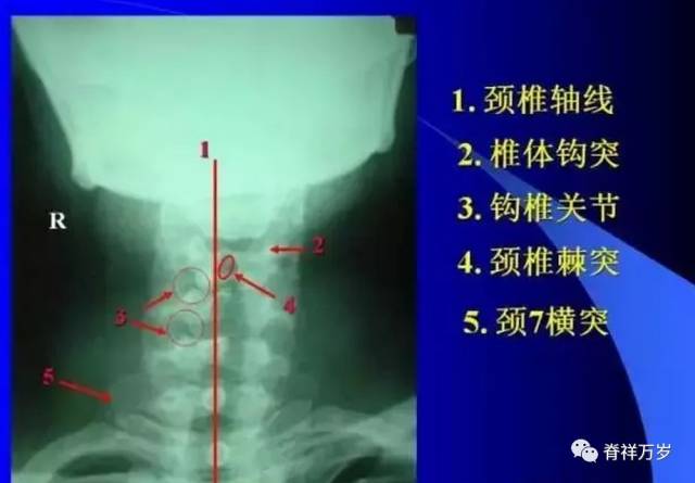 1,颈椎轴线 2,椎体钩突 3,钩椎关节 4,颈椎棘突 5,颈7横突