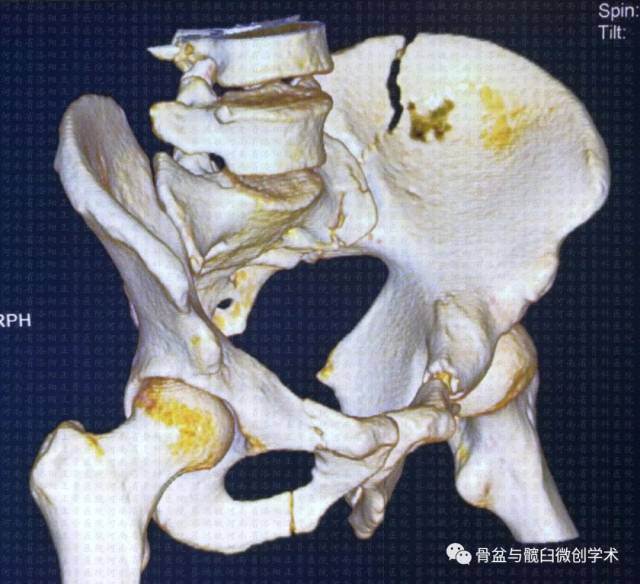 经髂骨&骶骨的骶髂关节骨折脱位的微创治疗:骶髂螺钉