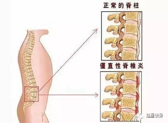 预防强直性脊柱