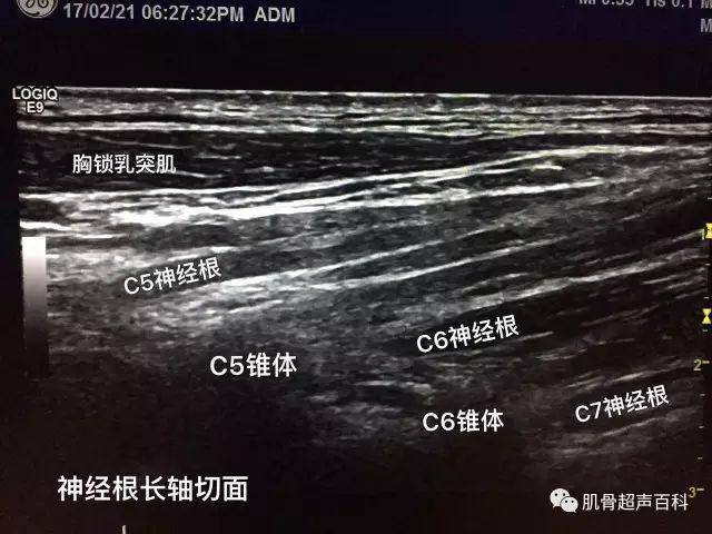 超声下臂丛神经的真面目(臂丛神经阻滞秘籍)
