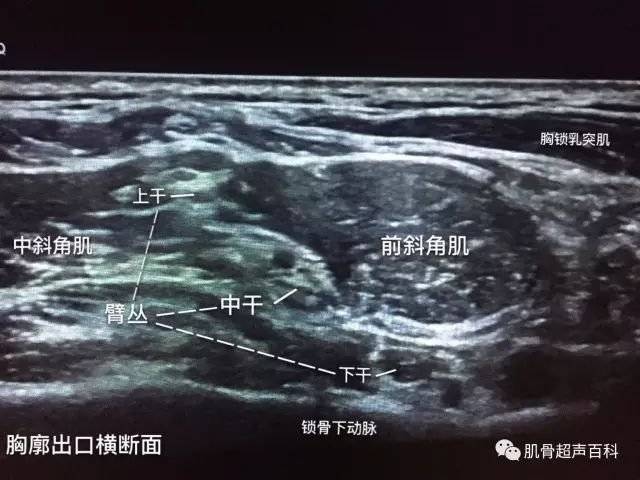 超声下臂丛神经的真面目(臂丛神经阻滞秘籍)