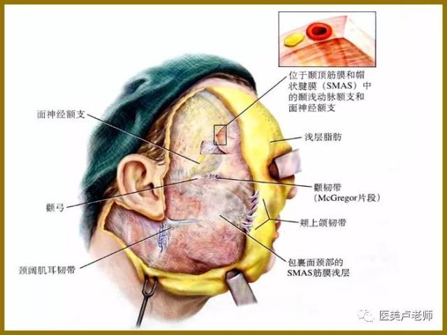 的老化包括以下4个解剖学方面的变化:即颧部脂肪垫下垂,睑颊结构下垂