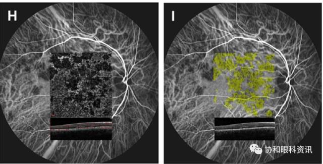 知否,知否,如何解读脉络膜的octa表现?(下)