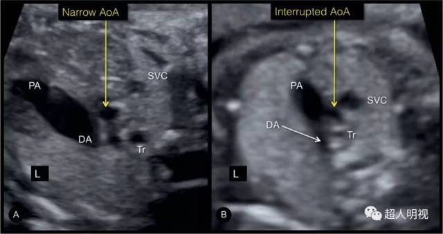 几个异常的胎儿三血管气管切面病例