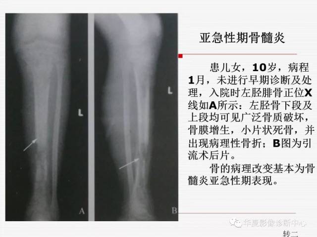 骨髓炎的影像学表现