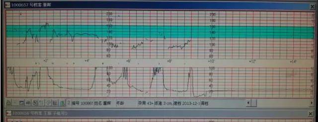 late decelerations)指在20分钟的胎心监测中 50,宫缩后出现晚期减速