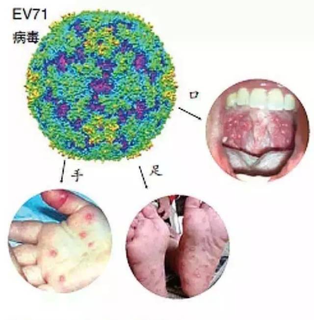 肠道病毒71型感染重症手足口病临床指标的应用研究