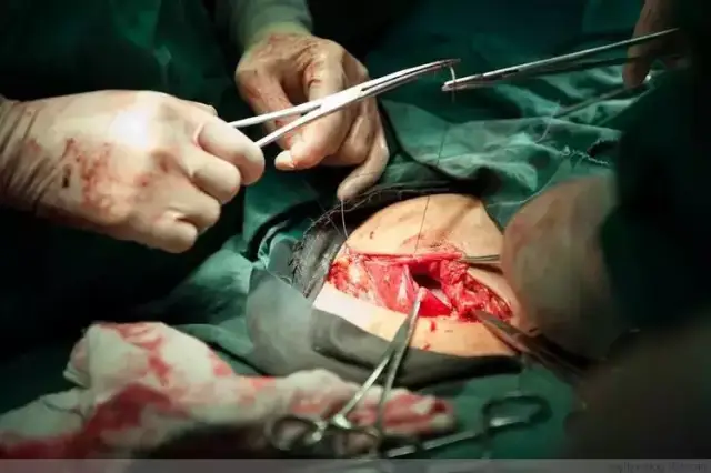 子宫缝完了,开始缝腹腔. 手术用的缝针是弯头的,这样便于操作.
