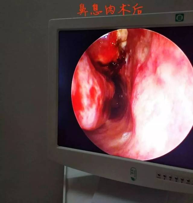 引进国内最前沿的检查仪器一一高清耳鼻喉内窥镜,结合中医中药鼻炎膏