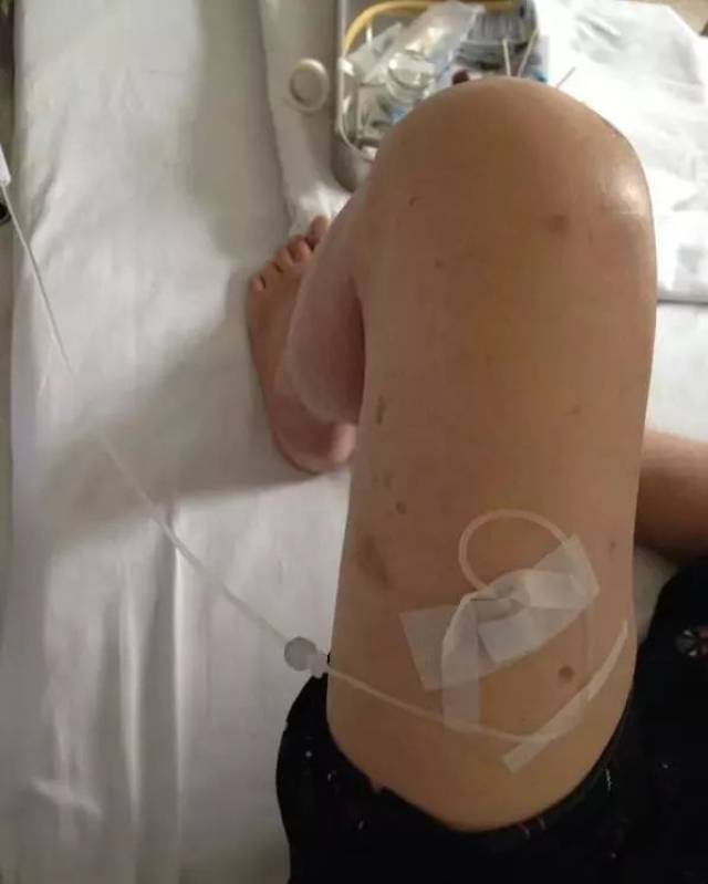 大腿,腿好像有点冷 这个病人无法下picc以及股静脉穿刺,我们想尽