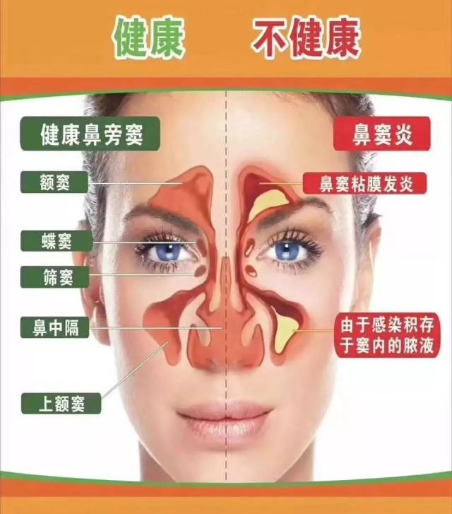 鼻剖面图健康与非健康形象对照
