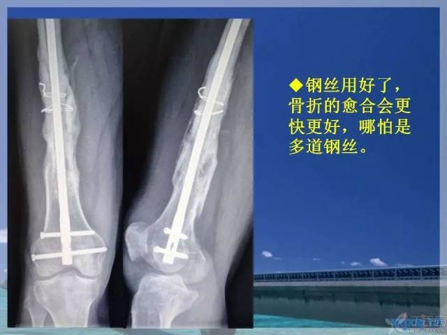 ppt 中提到蝶形骨块移位大于 1cm 会影响股骨干骨折的愈合,这是一个