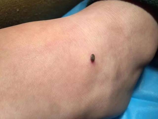 发现了异样,原来这并不是一颗痣,而是蜱虫叮咬在了皮肤上,通常蜱虫
