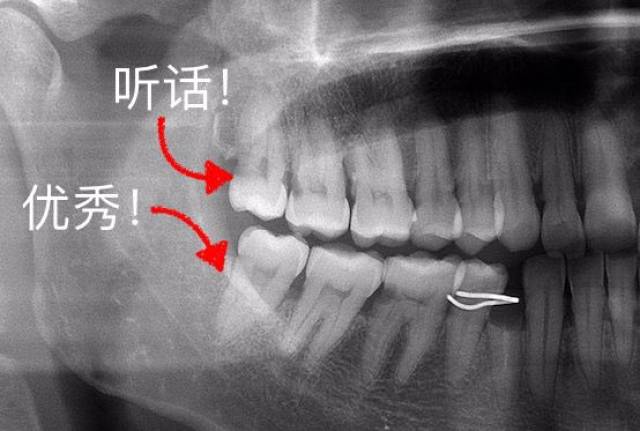 整齐,正位萌出的智齿