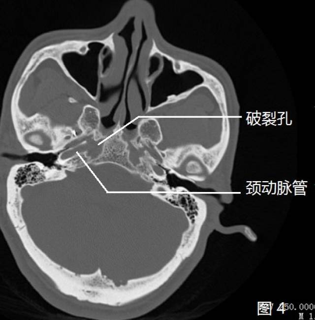 【推荐】颈内动脉走形图谱(2):岩段和破裂孔段