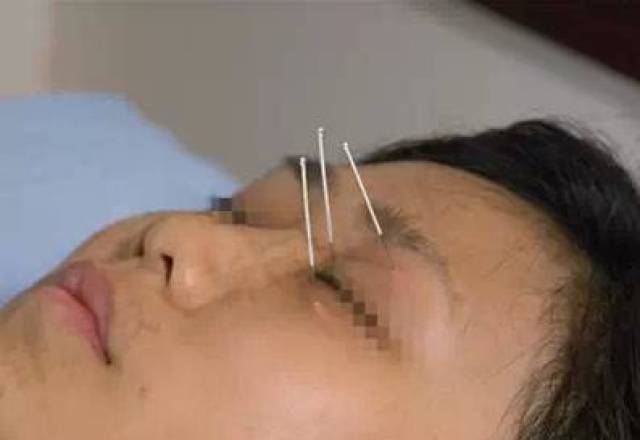 针灸:靳三针9组穴位(图文并茂)