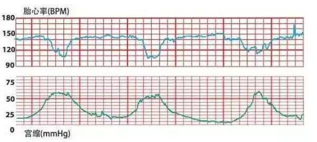 变异减速(variable decelerations)