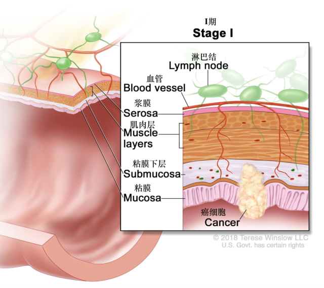 iia期:癌症已经通过结肠壁的肌肉层扩散到结肠壁的浆膜层(最外层.