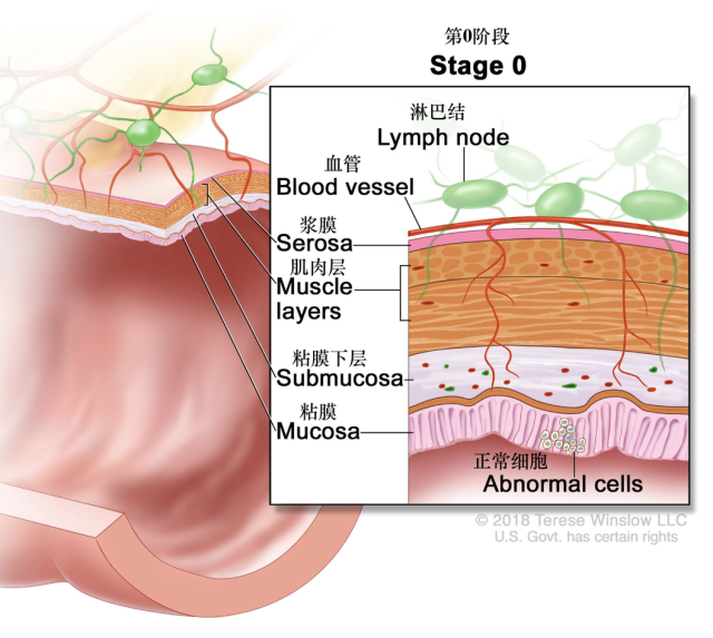 iia期:癌症已经通过结肠壁的肌肉层扩散到结肠壁的浆膜层(最外层.