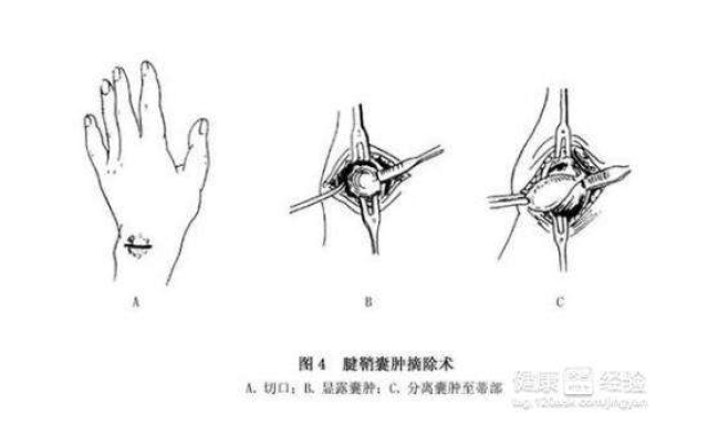 发作或囊肿后期坚硬,手术必须仔细将全部囊壁连同周围部分正常的腱鞘