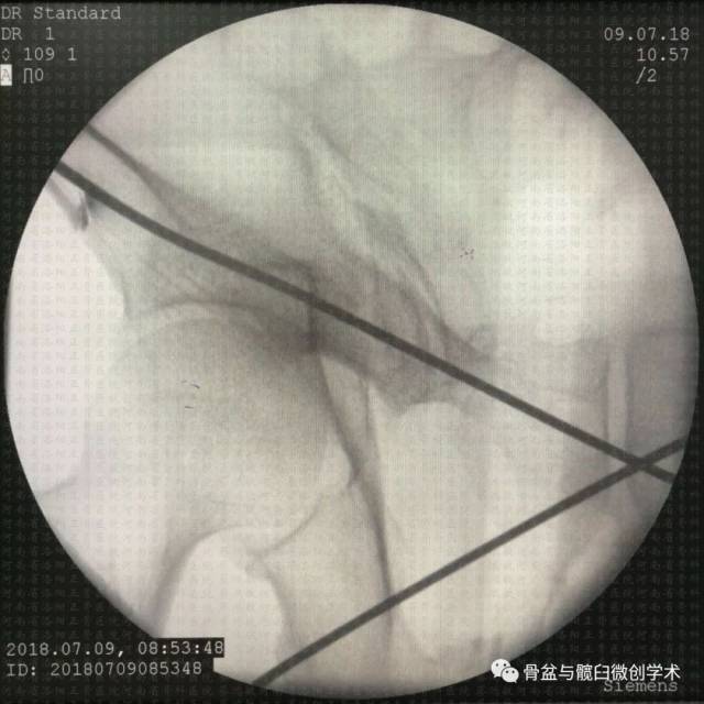 逆行耻骨上支螺钉